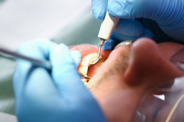 Best Dentist for Tooth Abscess  in South San Gabriel, CA