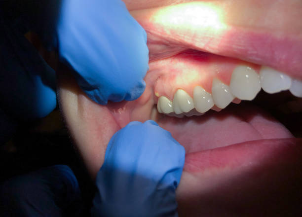 Best Chipped Tooth Repair Near Me  in South San Gabriel, CA